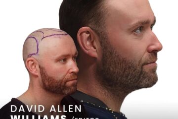 Baerstool's Hair Transplant