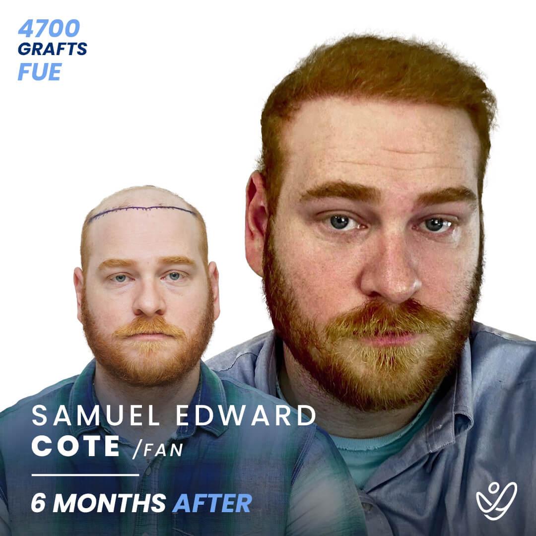 Hair transplant journey in Turkey