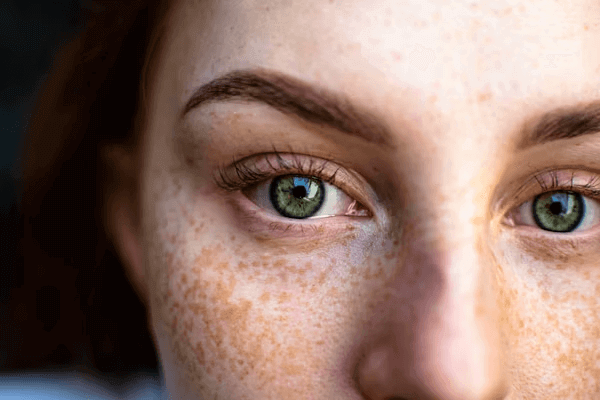 Woman with freckles on face and eyelids